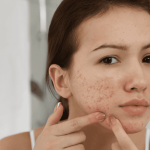 Tips Memilih Skincare yang Cocok untuk Kulit Sensitif Berminyak dan Berjerawat